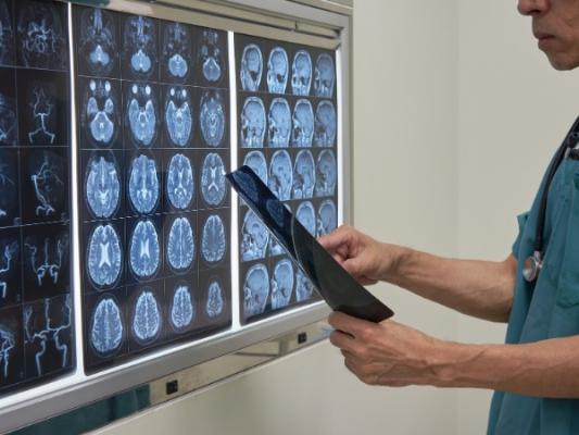 Blood pressure combination pill cuts repeat stroke risk by 40%, global study finds